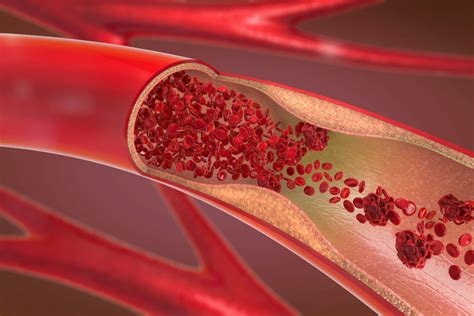 cum să consolideze hemoroizii varicoase vaselor de sânge